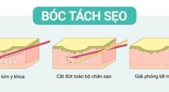 Kĩ thuật bóc tách đáy sẹo là gì? Ưu, nhược điểm và hiệu quả