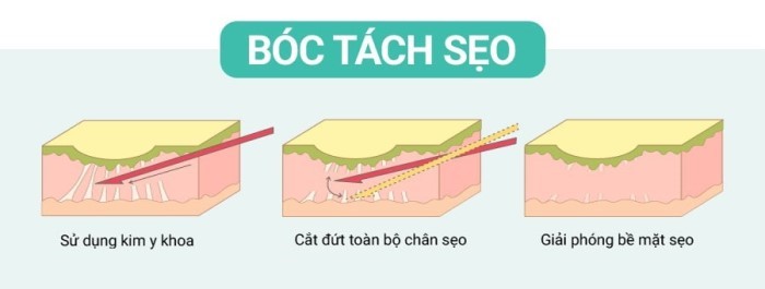 seo Kỹ thuật bóc tách sẹo đang được áp dụng rộng rãi trong điều trị sẹo rỗ